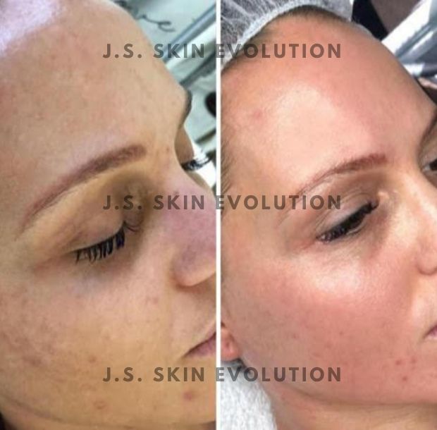 J.S. Skin Evolution Microneedling 2